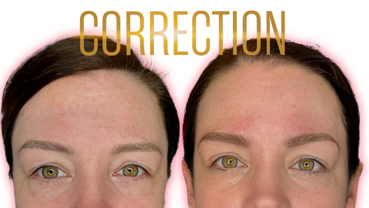 brow correction results after assessment