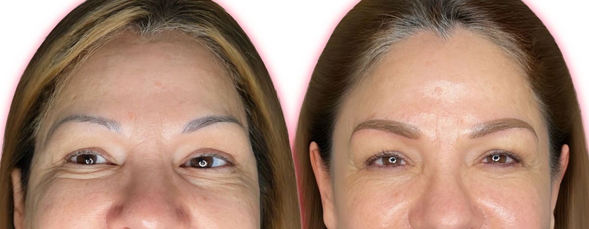 difficult brow correction consultation