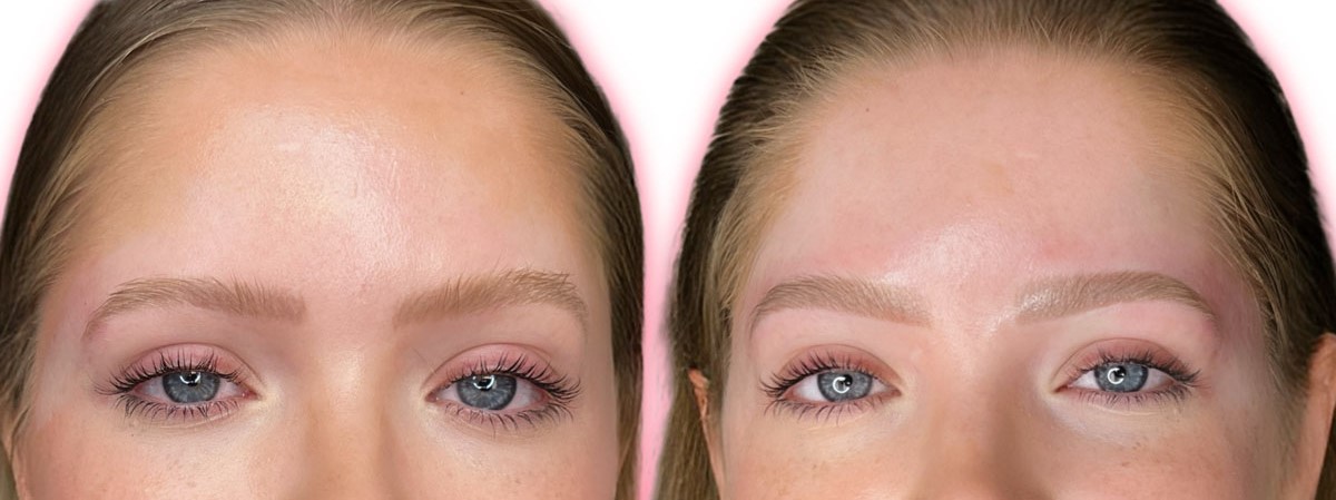 repeated microblading without correction causing brow changes Dallas TX