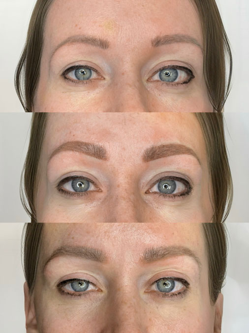 Before and after uneven eyebrow tattoo repair showing previous cosmetic eyebrow tattoo professionally repaired into balanced, symmetrical brows.
