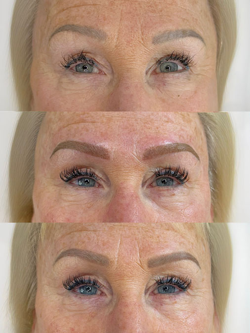 Before and after grey eyebrow tattoo correction showing unwanted cool healed pigment professionally corrected into a more balanced eyebrow.