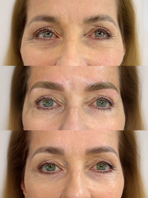 efore and after previous microblading correction showing older healed hairstrokes professionally corrected for a more balanced appearance.