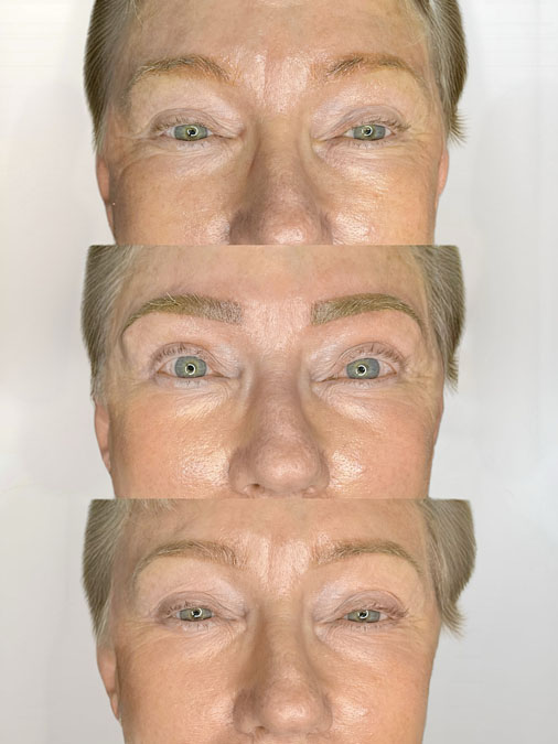 Before and after red eyebrow tattoo correction showing previous microblading with unwanted red tones professionally corrected.