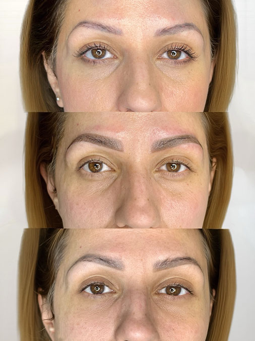 hree-stage eyebrow tattoo repair journey showing previous eyebrow tattoo before repair, immediately after treatment and the final healed result.