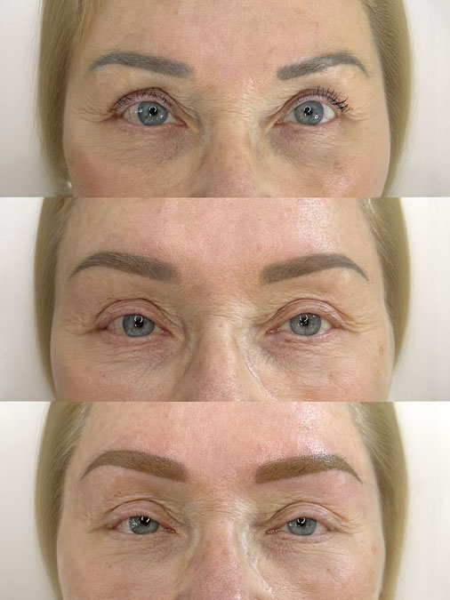 1990s Eyebrow Tattoo Correction Before and After