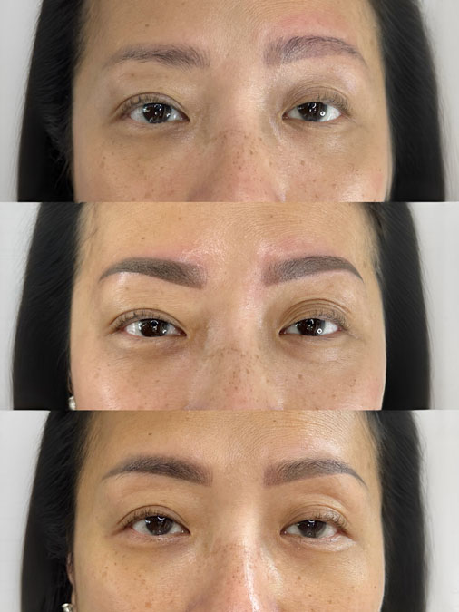 Before and after uneven eyebrow tattoo correction showing previous cosmetic eyebrow tattoo professionally balanced for improved facial harmony.