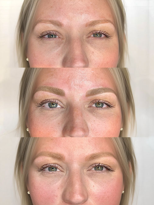Before and after poor microblading shape correction showing healthier eyebrow proportions.