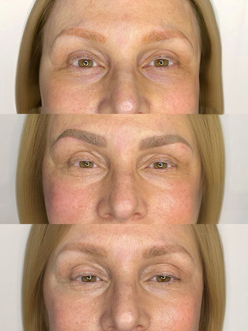 orange eyebrow tattoo correction focuses on restoring natural color rather than increasing darkness.